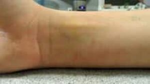 si-nb-bruised-wrist-220
