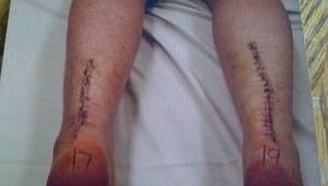 mi-stitches