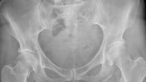si-osteoporosis-hip-220-cp-
