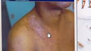 si-body-lice-bites_1