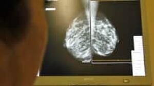 si-mammogram-breast-220-cp-