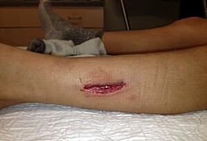 wdr-220-kevlar-injury