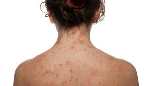 Eczema Atopic dermatitis