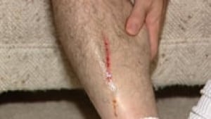si-ott-sinkholeinjury-220