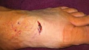 hi-bite-no-bandage-3col