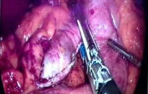 obesity-surgery-325