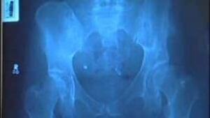 tp-cgy-hip-xray