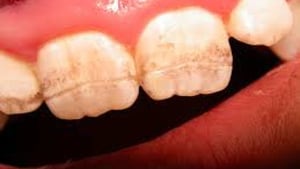 Celiac Teeth