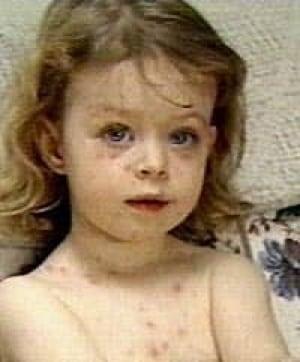 chickenpox-shingles040907