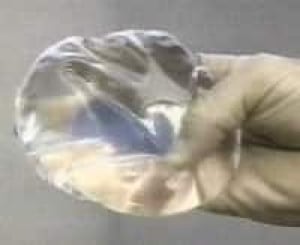 breast_implant