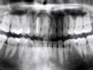 teeth-xray-cbc