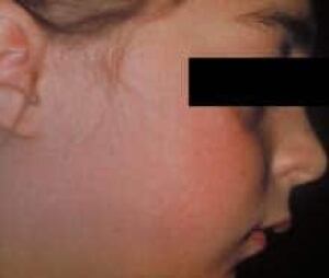 rubella_facerash050321