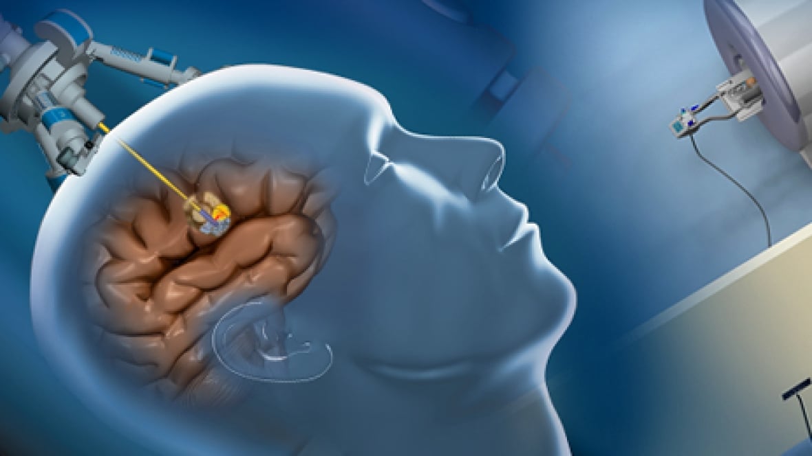 Winnipeg duo wins 100K innovation award for brain surgery laser