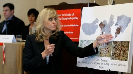 In this Tuesday Jan. 27, 2009 file photo, Dr. Ann McKee, of Boston University School of Medicine, talks about damaged human brains during a news conference about chronic traumatic encephalopathy in Tampa, Fla. Researchers studying a degenerative disease in former athletes say 11 of 12 brains of deceased former NFL players tested over the past year showed signs of chronic traumatic encephalopathy, or CTE, continuing a trend they've been tracking. Ann McKee, chief of neuropathology at the VA Boston Healthcare System, told PBS: "People think that we're blowing this out of proportion, that this is a very rare disease and that we're sensationalizing it. My response is that, where I sit, this is a very real disease." NFL-Brain Disease Research Football