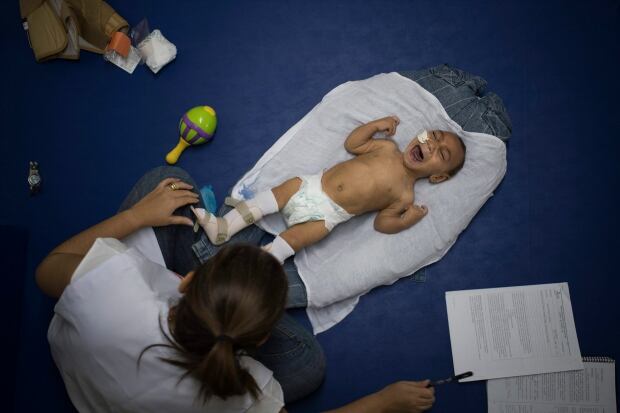 Brazil Zika Babies Photo Gallery