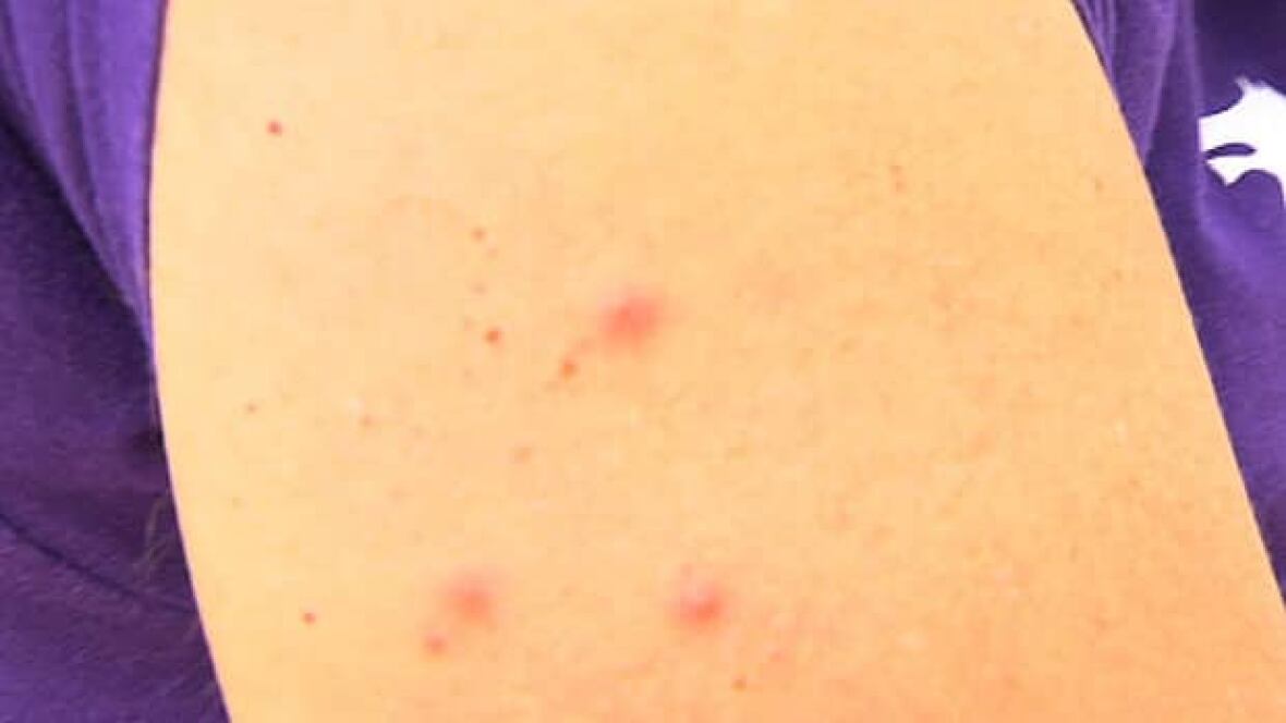 10 family members get swimmer's itch at Winnipeg Beach Manitoba CBC