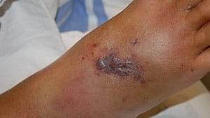 mi-bc-130322-tiffan-akins-vgh-snake-bite-cu