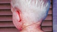 hi-measles-852-cp-01470443
