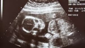 ii-ultrasound-istock