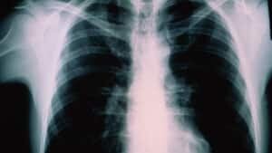 mi-chest-xray-getty6104-000452