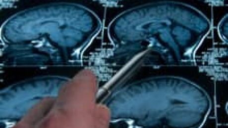 si-brain-scan-220-istock