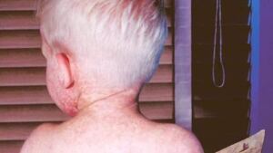 li-measles-620