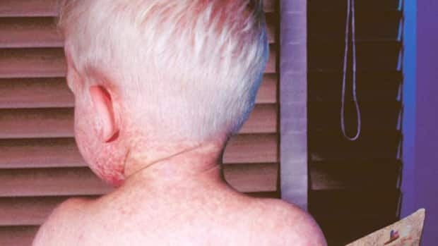 li-measles-620