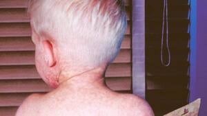 hi-measles-852-4col