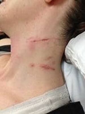 mi-neck-wounds