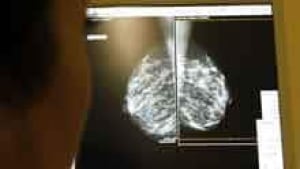 si-mammogram-220-cprtx57zf