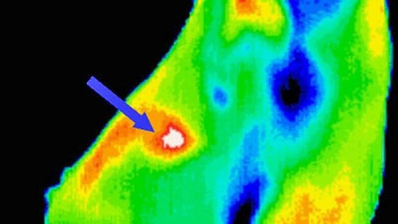 breast thermography toronto Breast thermography toronto