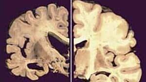 si-alzheimers-brain-03864296