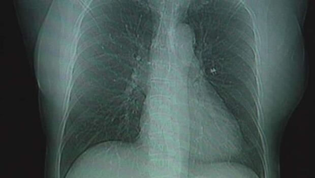 Asbestos in Cassiar