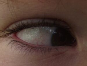 Marie Debow's irritated eyes