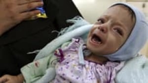 si-malnutrition-child-220-c