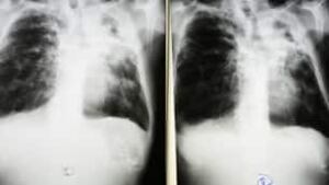 tp-tb-xray-cp-7869316