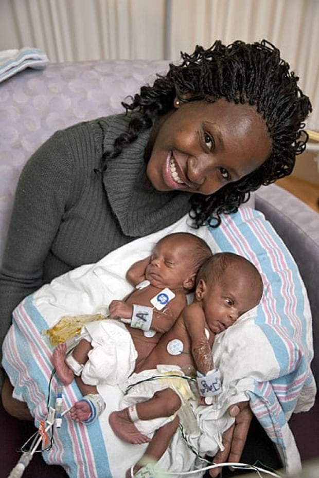 conjoined-twins-430-cp-0127