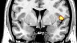 si-brain-mri-insula-120cp