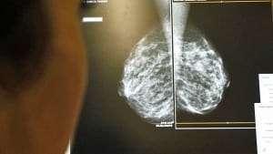 hi-mammogram-852-cp-rtx57zf