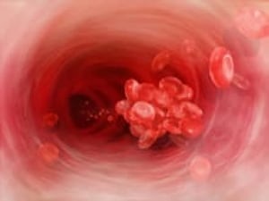 si-blood-clot-220