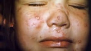 si-chickenpox-220-cp-cdc