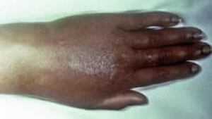 si-gonorrhea-hand-220-cp-cdc