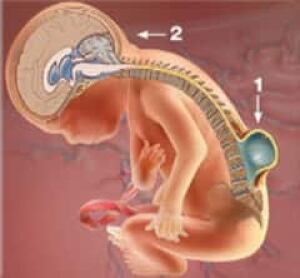 wdr-spina-bifida-graphic-credit-childrens-hospital-of-philadelphia