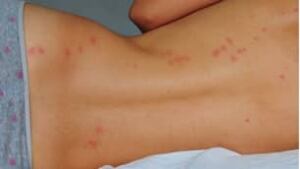 bedbugs-back-istock