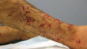 bc-090504-hovaizavi-bite-wounds