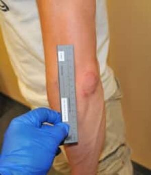 mtl-lapointe-arm