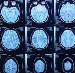 multiplesclerosis_chart0411