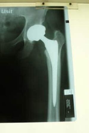 HIP-260