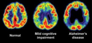 alzheimer_pet-scans090714