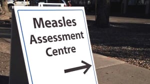Measles sign